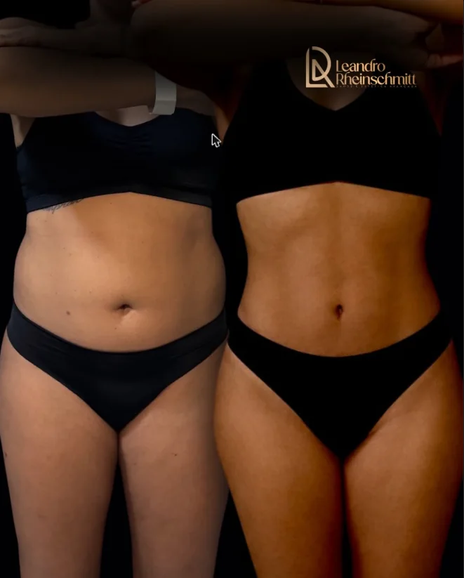 Antes e depois de paciente — contorno abdominal