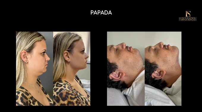 Antes e depois de dois pacientes — região da papada